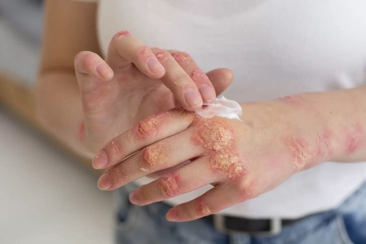 Skin Infections