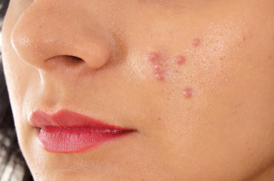 Acne & Pimples