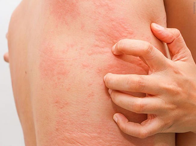 Allergy & Urticaria