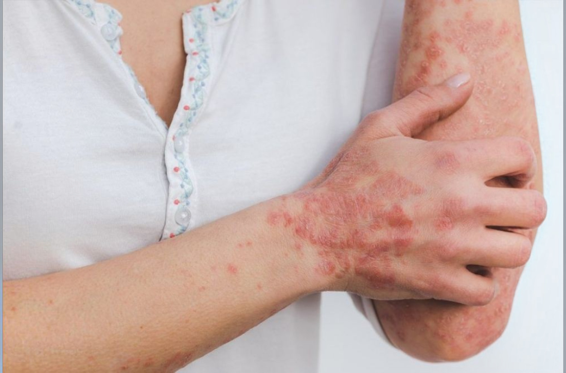 Psoriasis