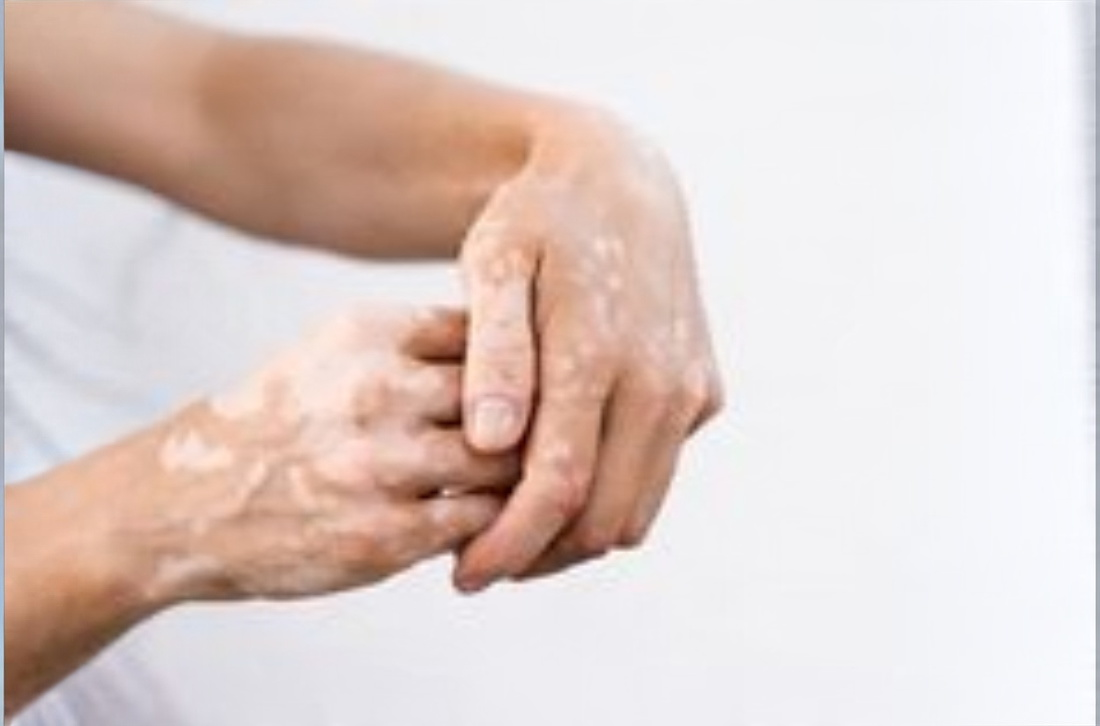 Vitiligo