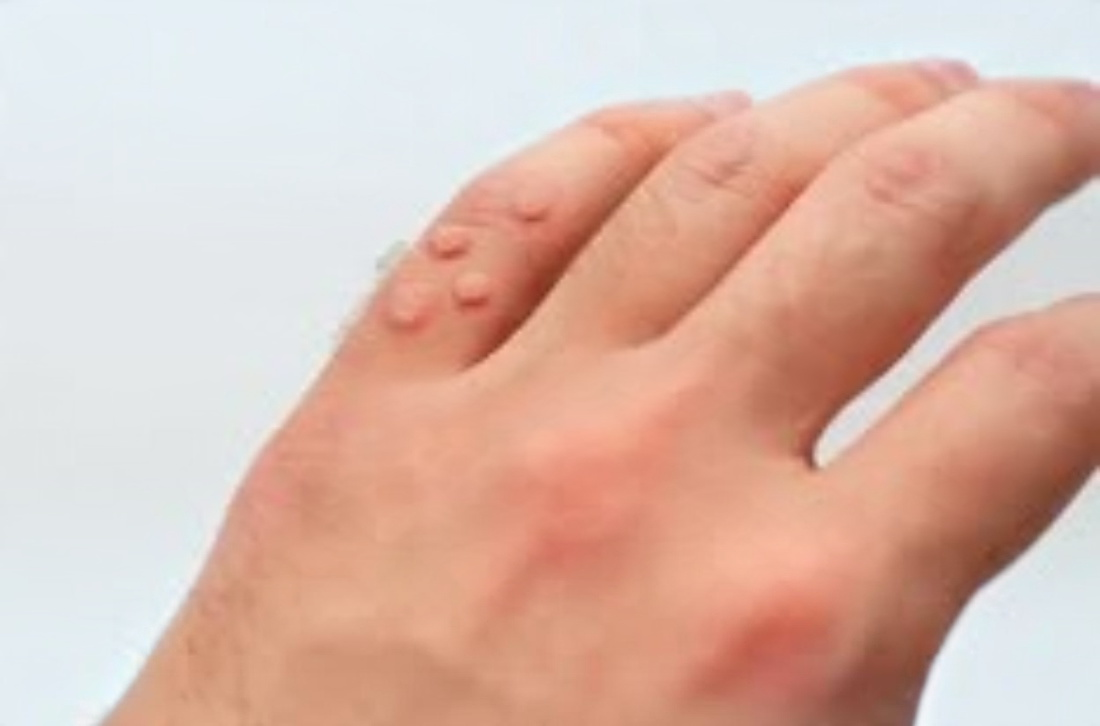 Warts, Corns & Callosities